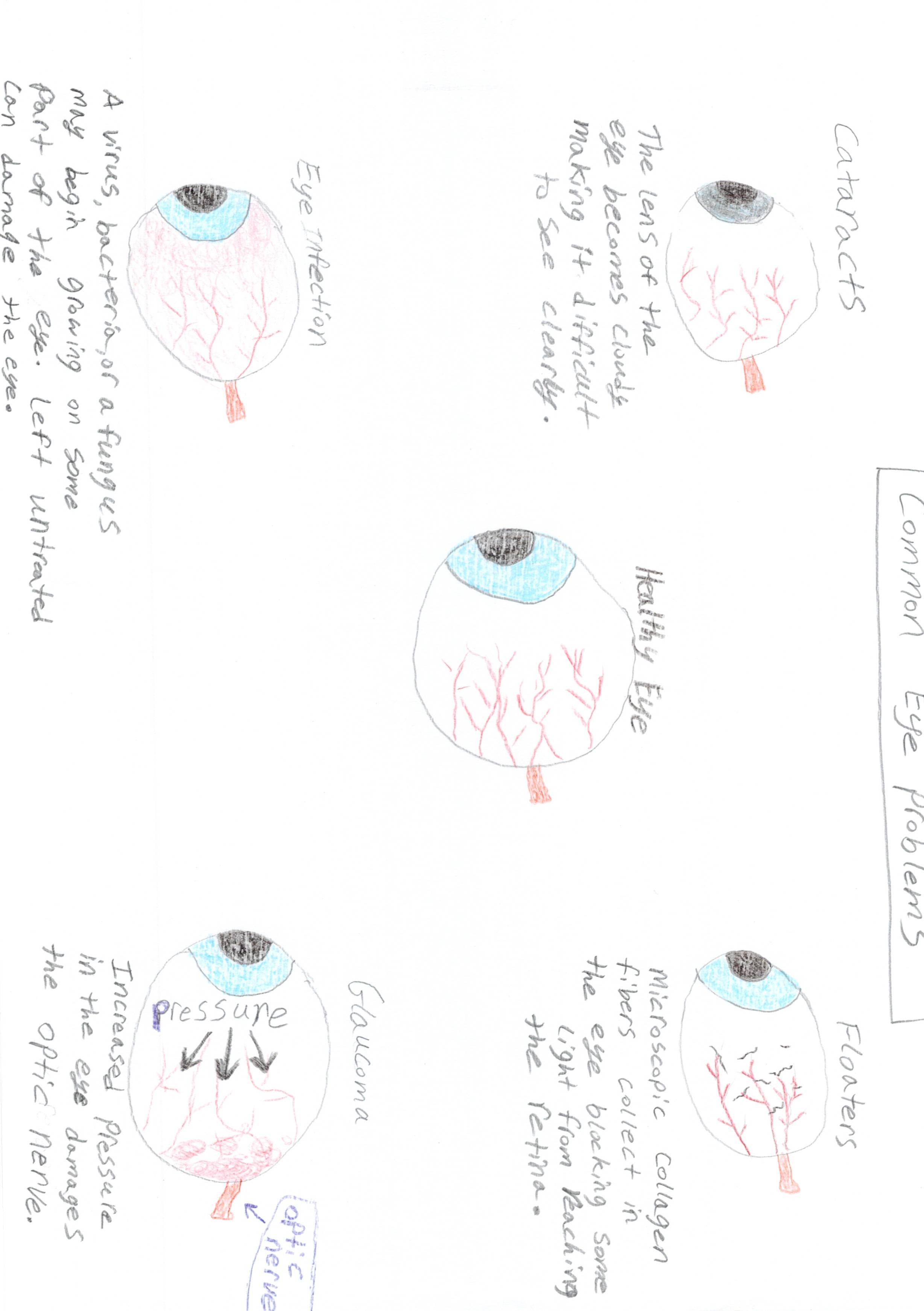 Eye Problems